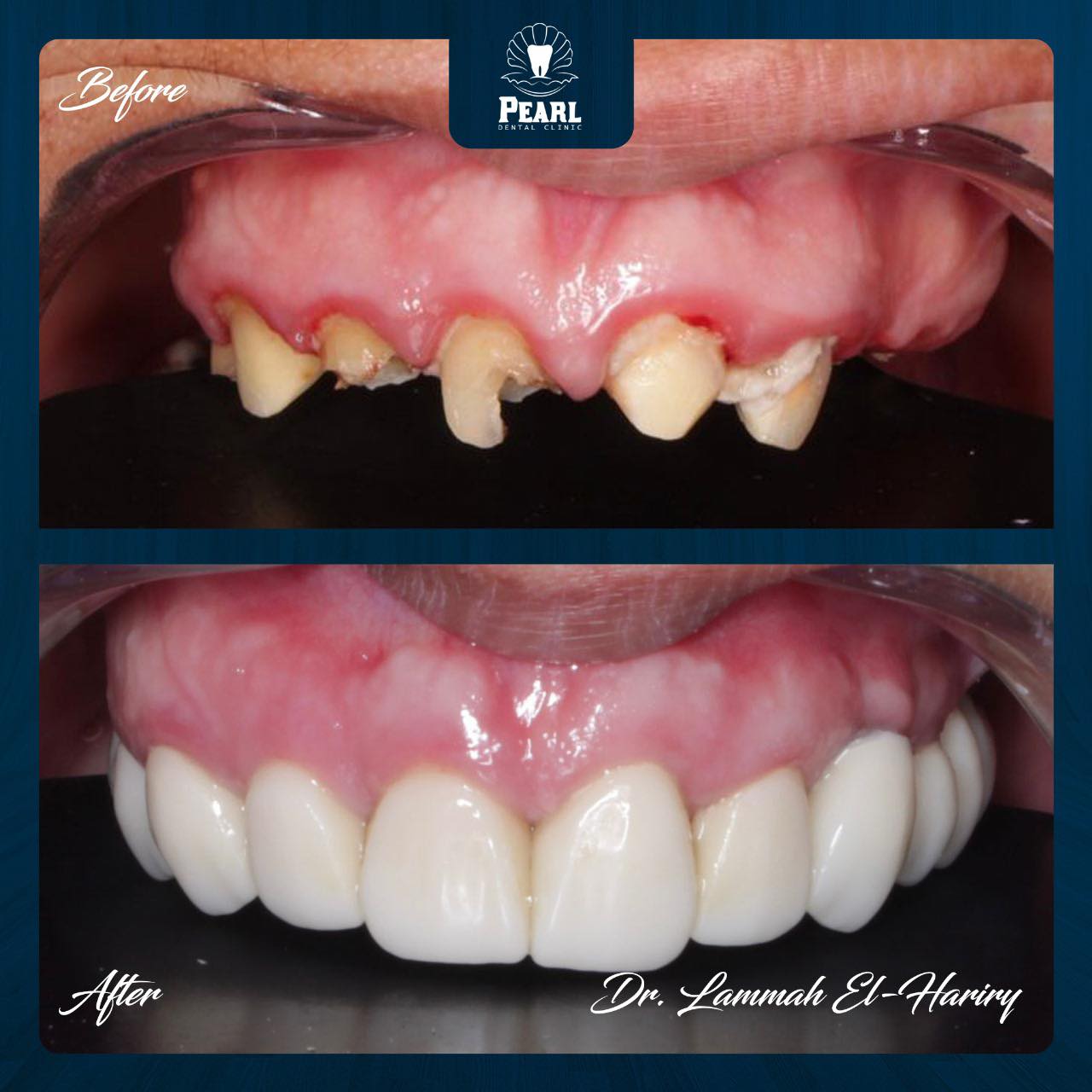 دكتور لماح الحريري - Pearl Dental Clinic Facebook ad: من حالة شبه مستحيلة لابتسامة مثالية!