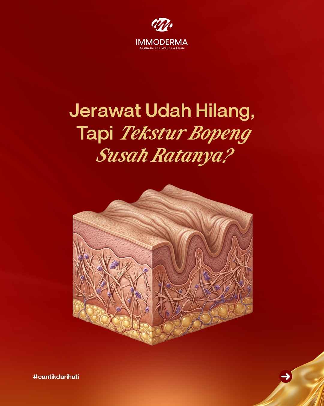 Immoderma Skin Clinic Supriyadi Semarang Facebook ad: Jerawatnya sih udah minggat, tapi jejaknya (bopeng) kok…