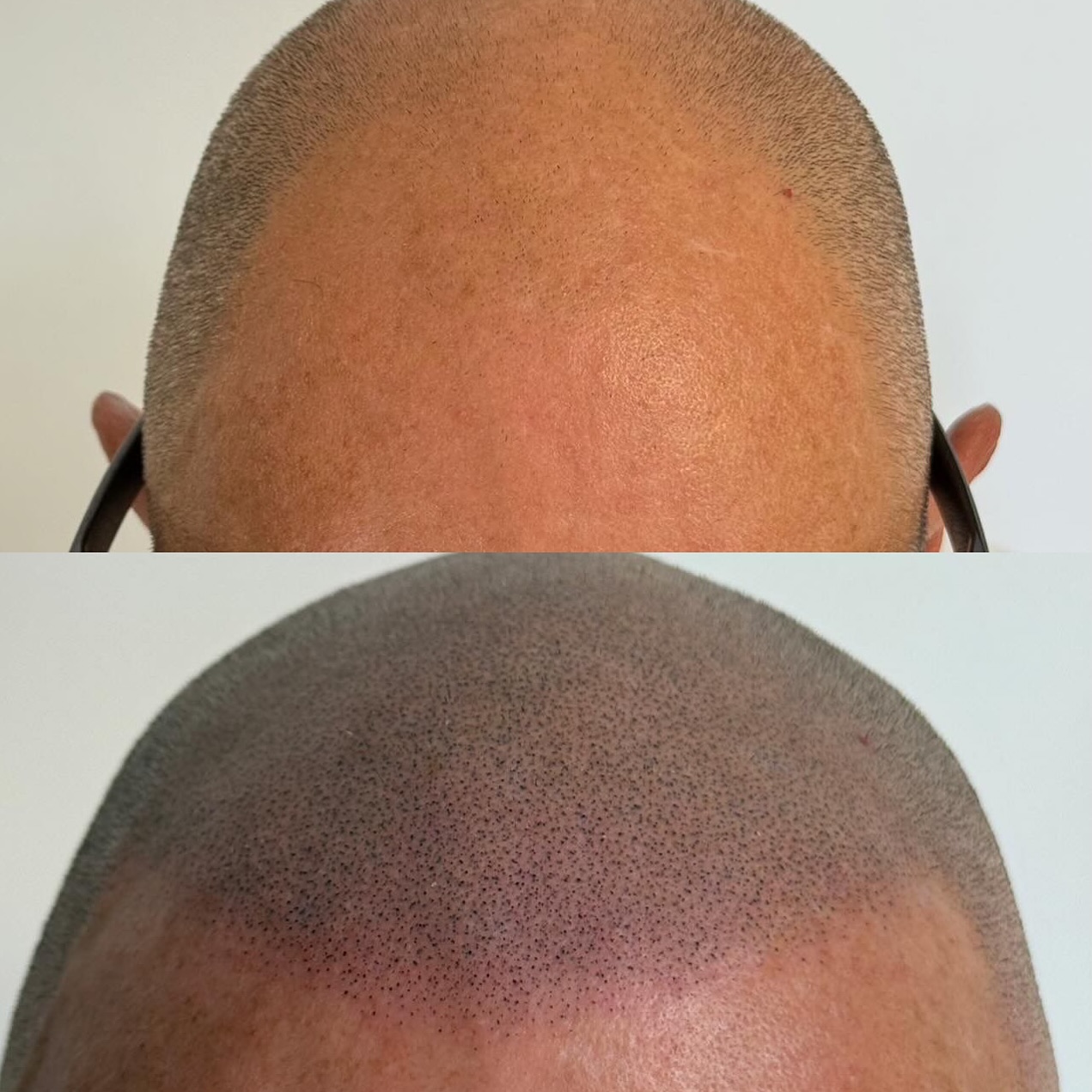 Micropigmentation Capillaire by. Idriss Soum Facebook ad