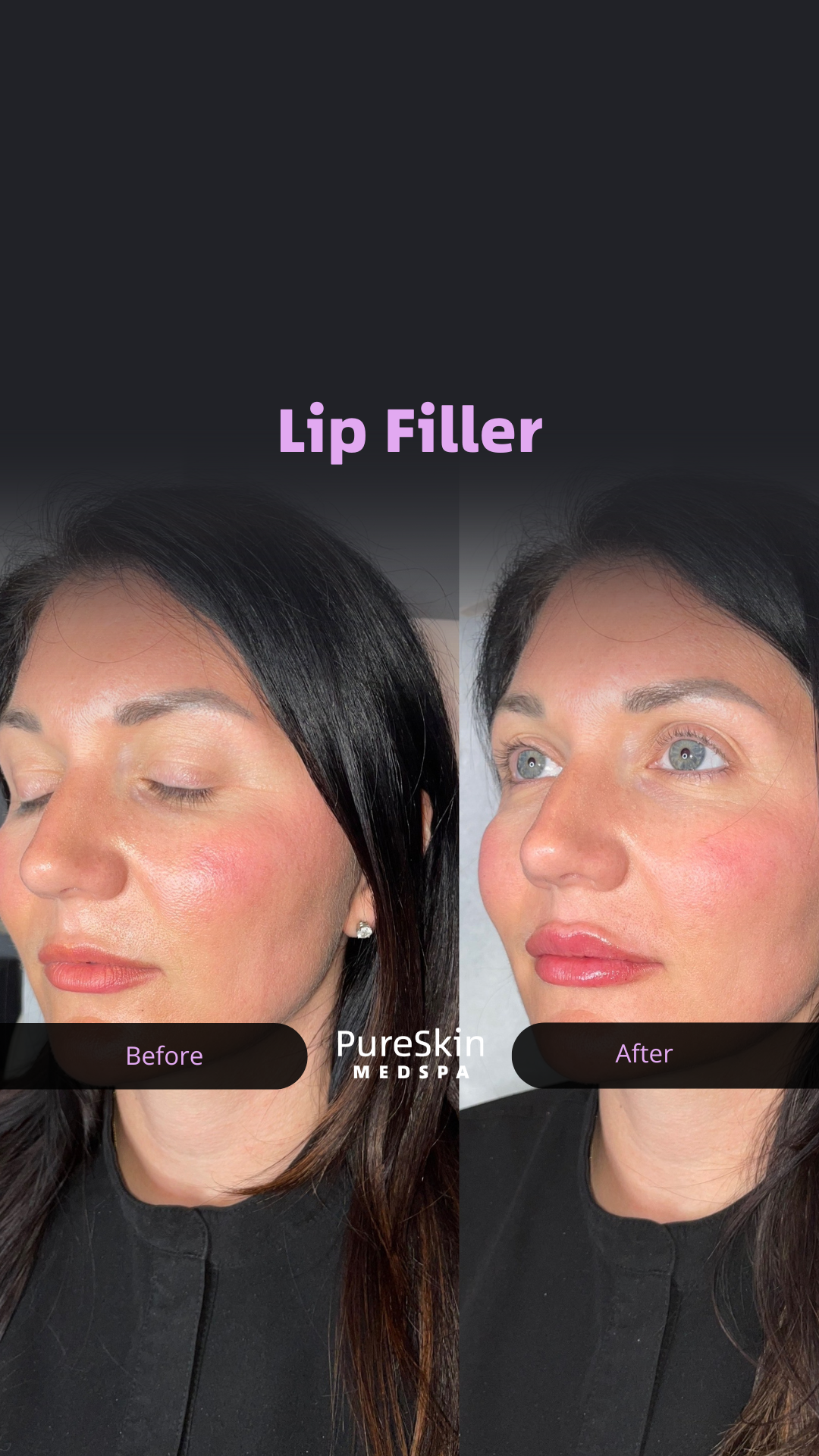 Pure Skin Facebook ad: CT MedSpa | Lip Filler That Looks Like You