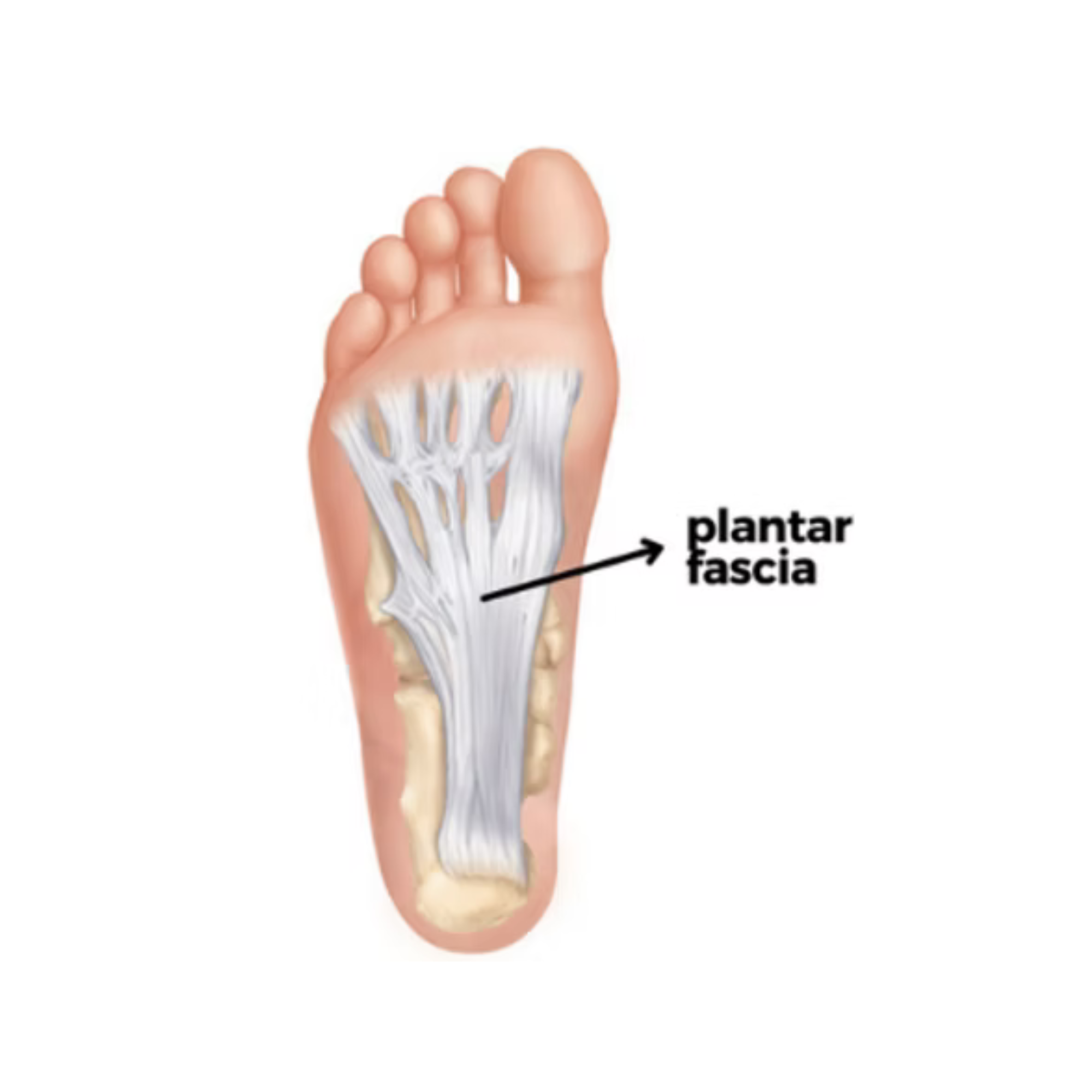 Sandra Roberts Facebook ad: Fix plantar fasciitis without custom orthotics or…