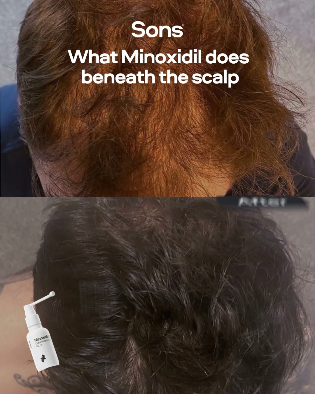Sons Facebook ad: Get ahead of hair loss