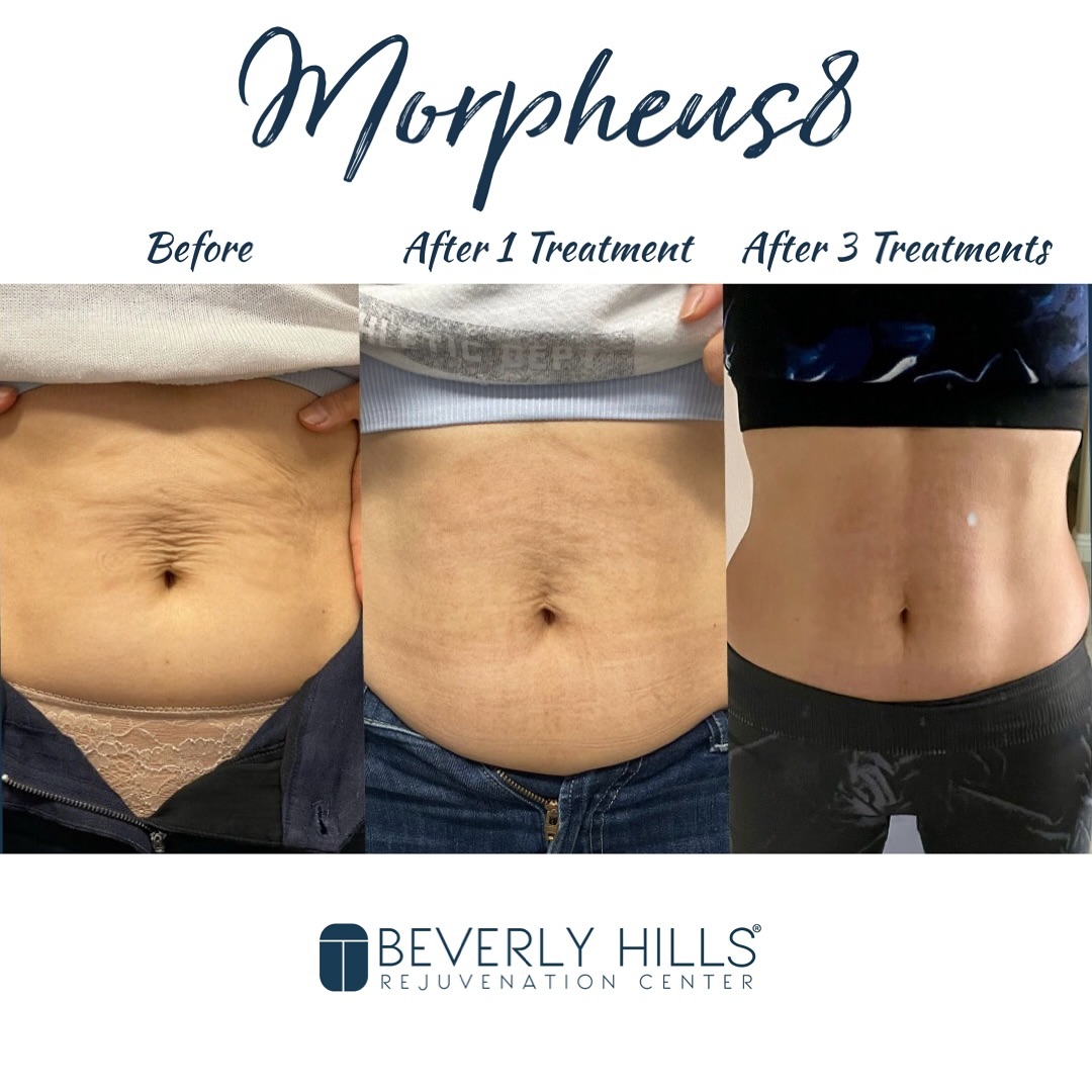 Beverly Hills Rejuvenation Center - Valencia Facebook ad