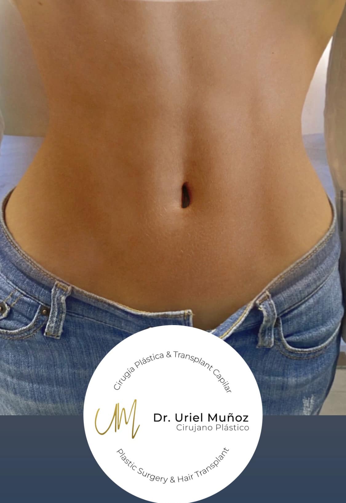 Cirugía Plástica Dr. Uriel Muñoz G. Facebook ad: LIPOESCULTURA CON MARCAJE SOFT ABDOMINAL