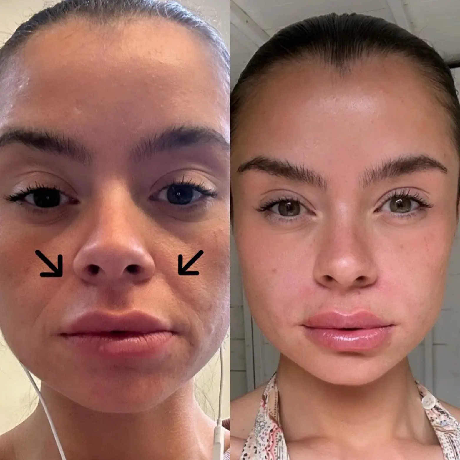 Emma's Skincare Blog Facebook ad: My answer for obsessively thinking about my smile lines…