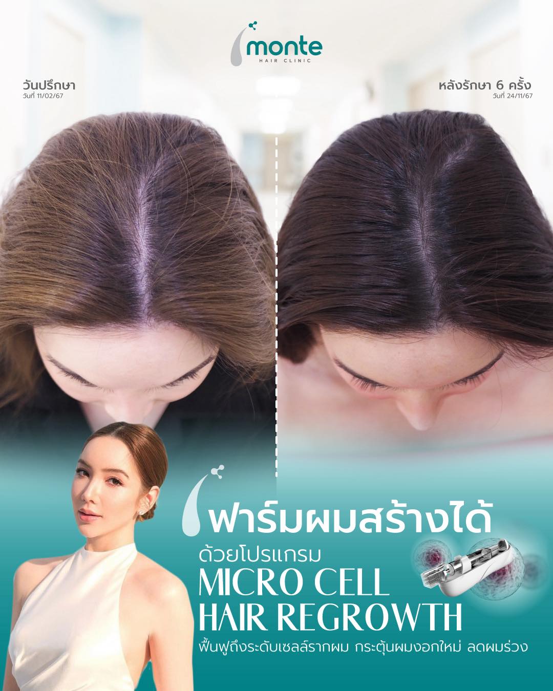 Monte Clinic - Hair Transplant ปลูกผมถาวร คิ้ว หนวดเครา รักษาผมบาง Facebook ad