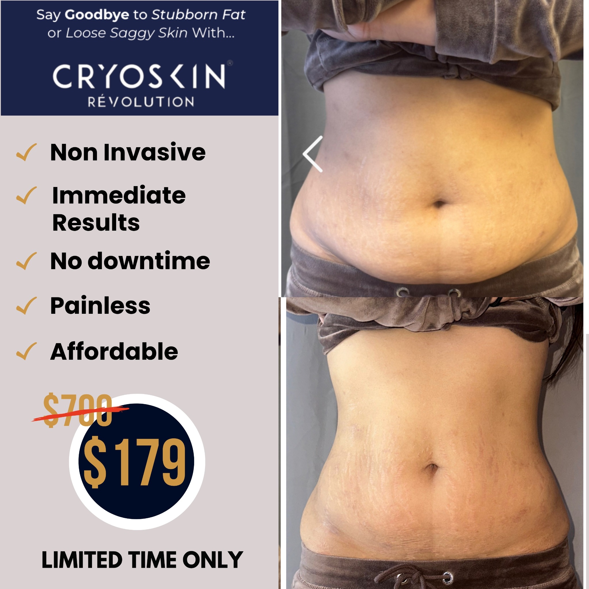 US Cryotherapy - Danville / San Ramon Facebook ad: Time To Fix Your Loose Skin
