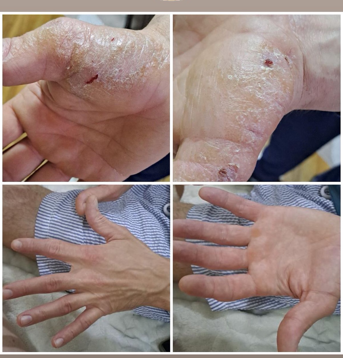 Hurem Melemi za kozna oboljenja Facebook ad: Dishidroza (dishidrotični ekcem) je kožno oboljenje koje se…