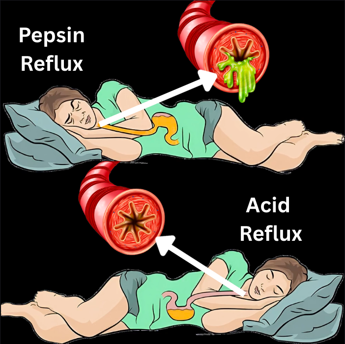 The Reflux Report Facebook ad