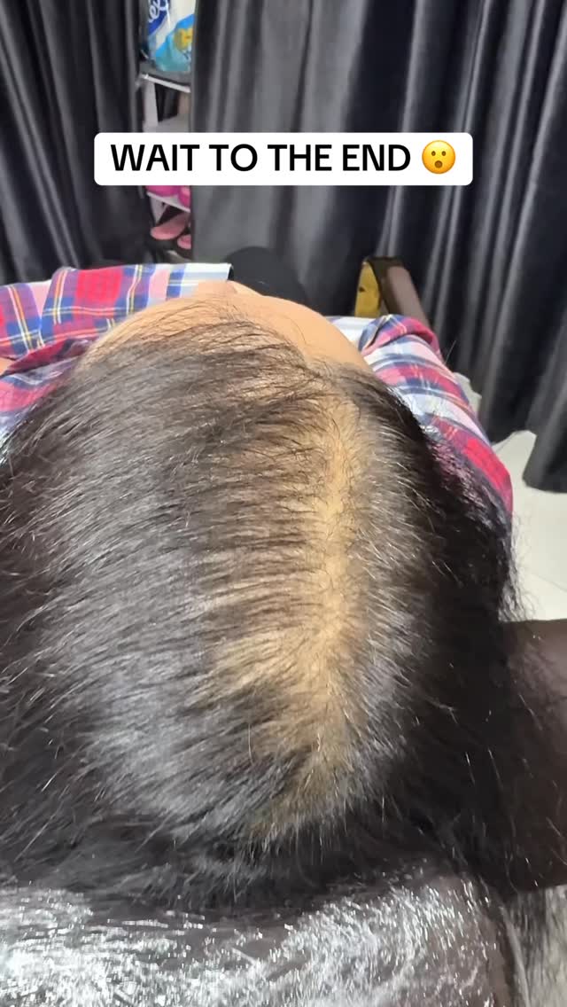 Micropigmentation Capillaire by. Idriss Soum Facebook ad