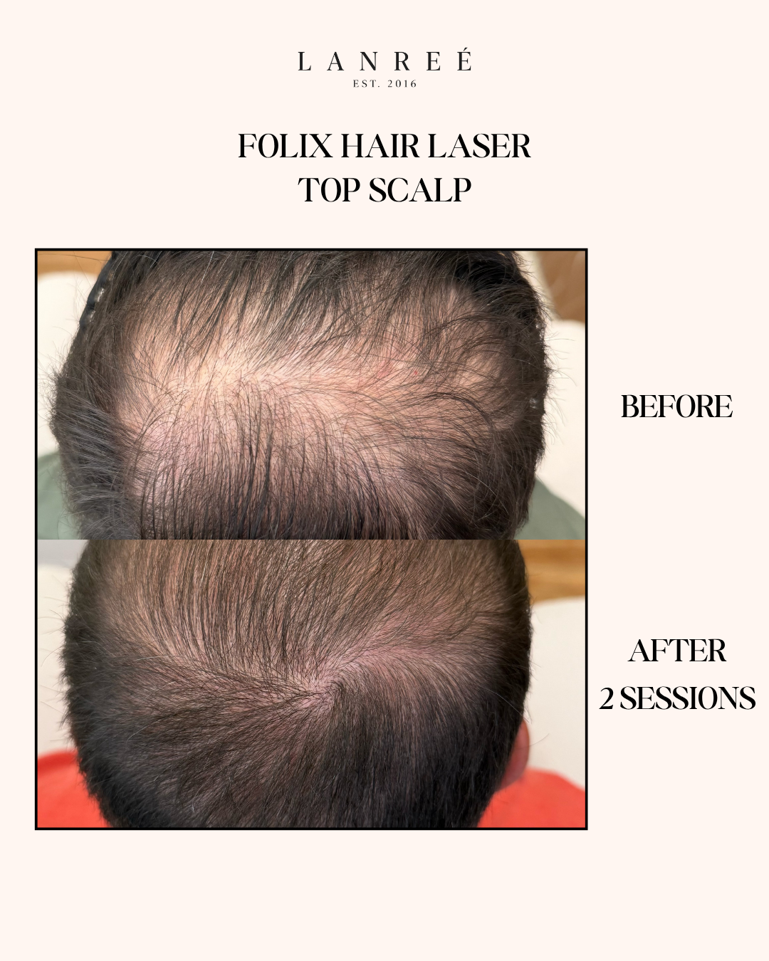 Lanree Aesthetics Facebook ad from Jun 17, 2026