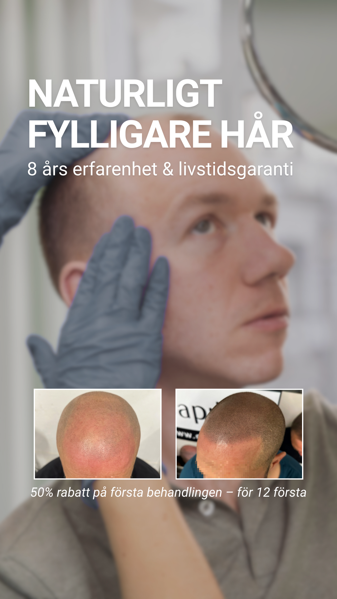 Scalp Micropigmentation Capillos Facebook ad from Mar 28, 2026