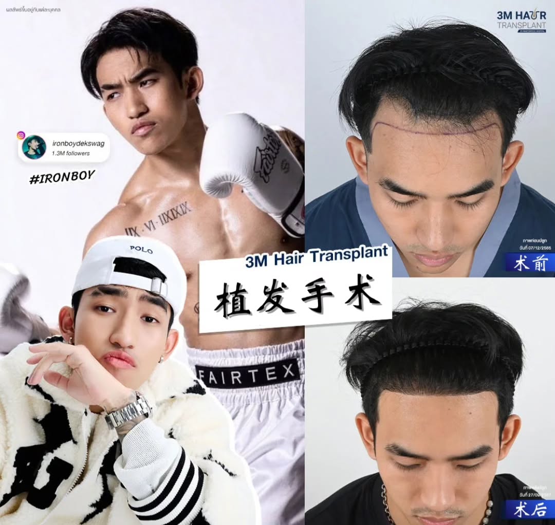 Masterpiece Hospital Chinese 中文客户服务中心 Facebook ad: 植发案例反馈的效果 !