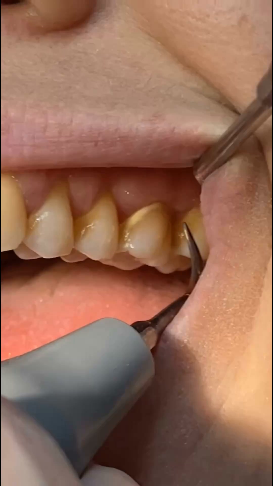 My Sweet Smile Facebook ad: Tired of hiding your smile? Try this