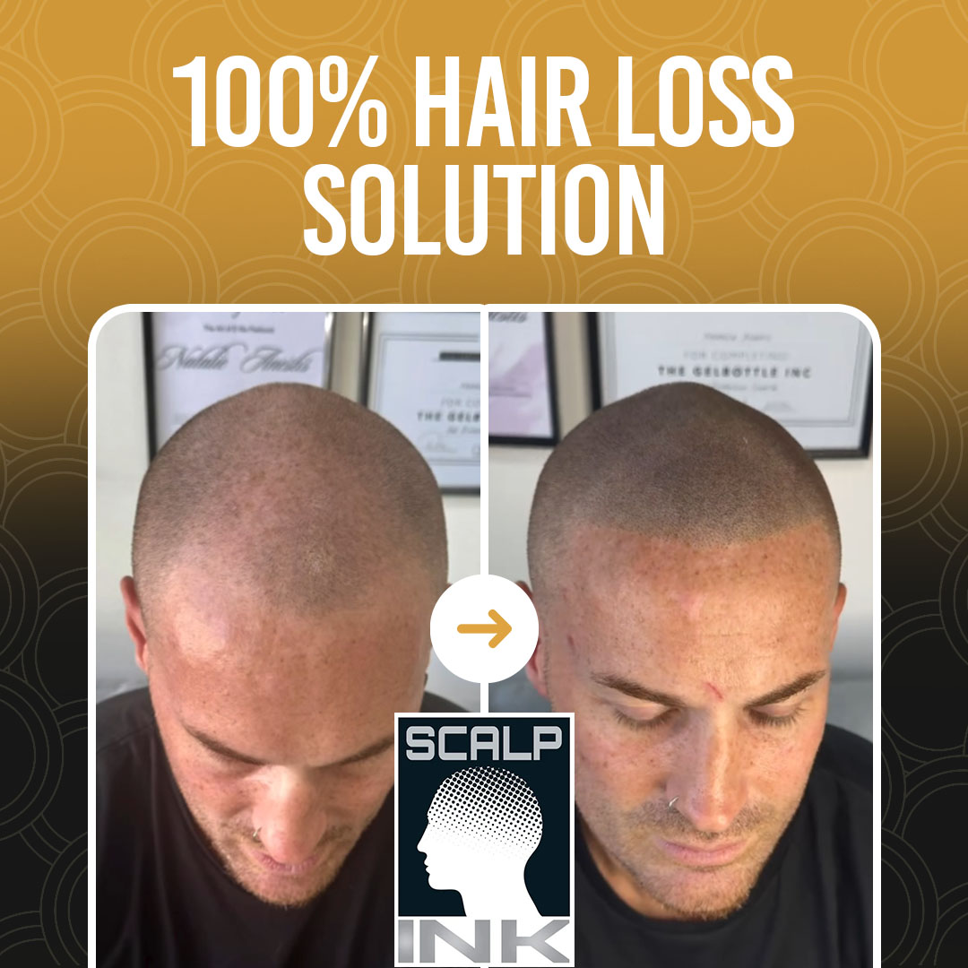 Scalp Ink Australia Facebook ad: Nunawading, 15% Off Scalp Micropigmentation