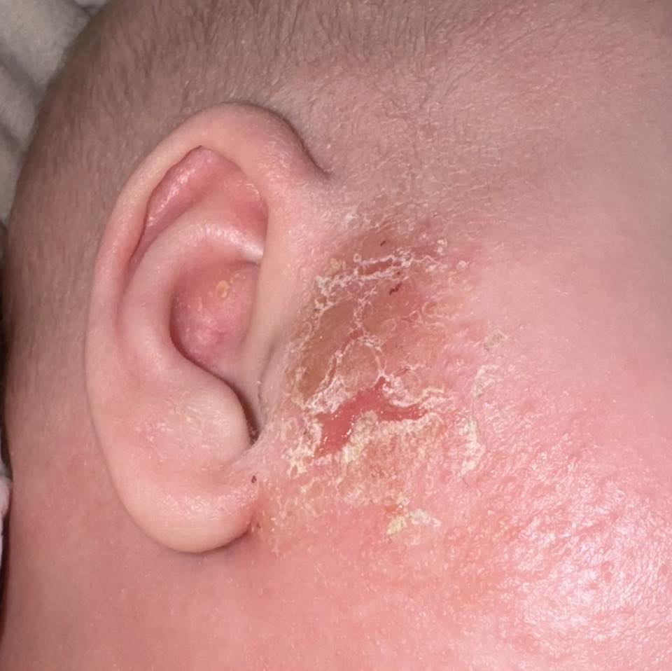 Jessica Rossi Facebook ad: Read this if your baby has eczema