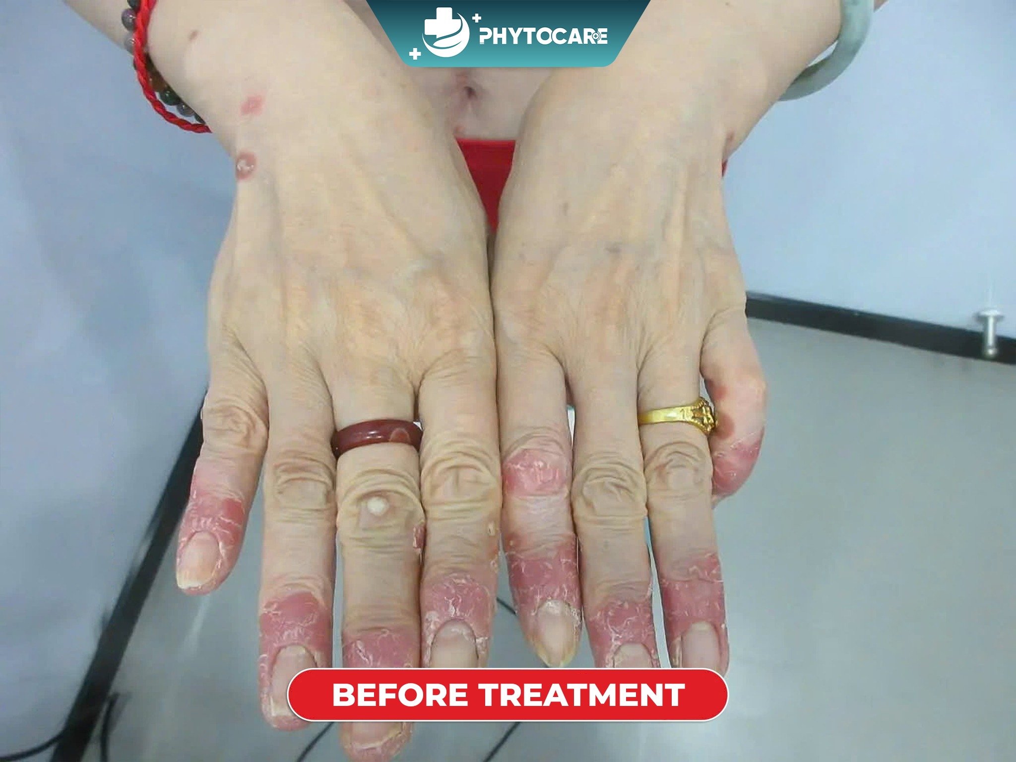 Fungus Scalp - Dermatology Clinic Cebu Facebook ad: IN CEBU CITY, say goodbye to itchy, burning…