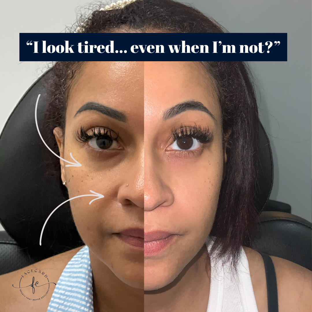 Dr Diva Aesthetics Facebook ad: I look tired… even when I’m not?