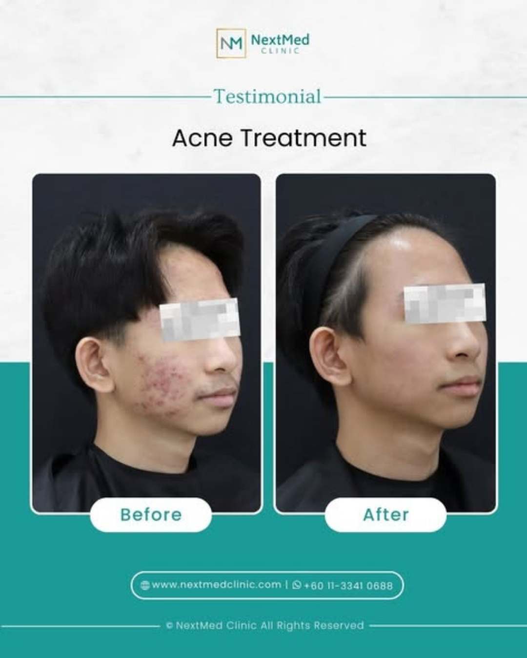 NextMed Clinic Cheras Facebook ad: From Severe Acne to Clear Skin in 90…