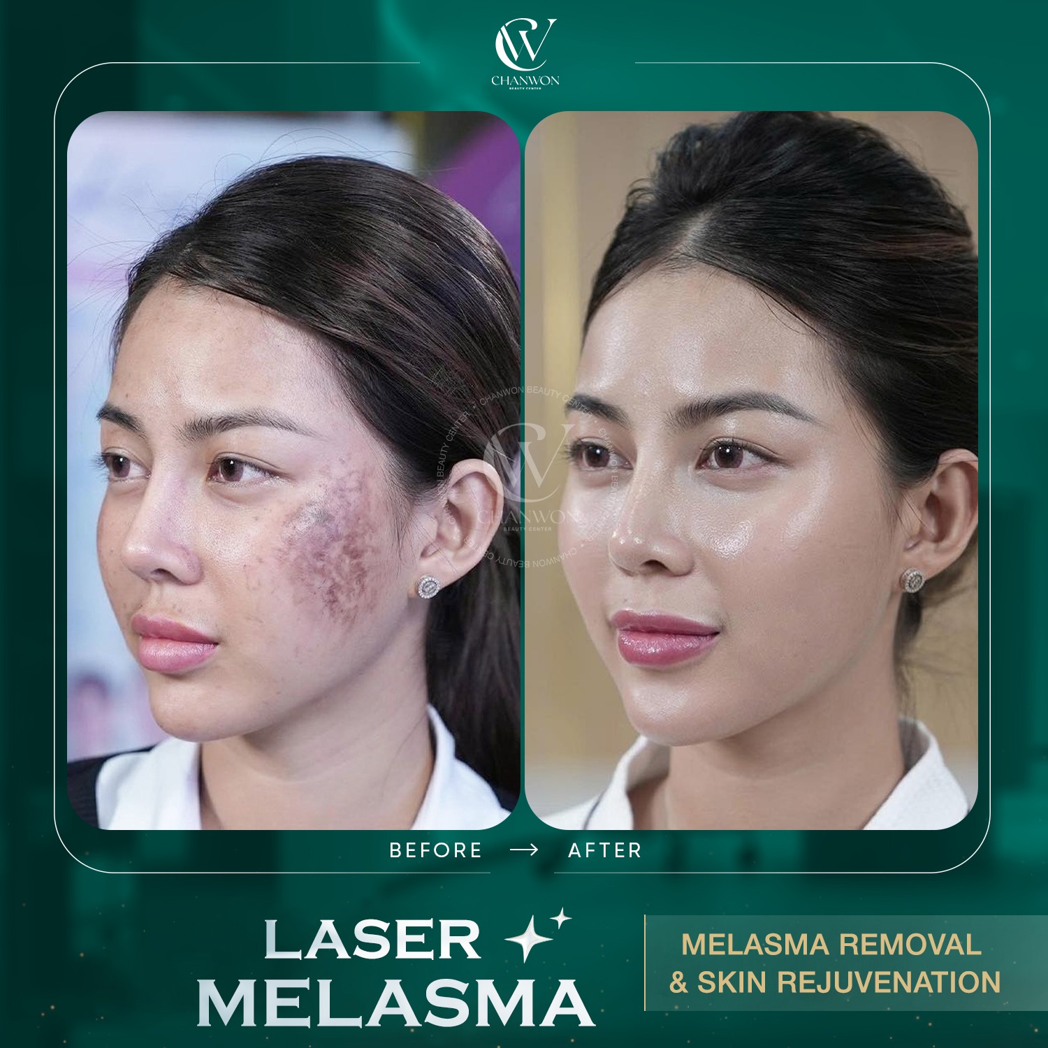 Chanwon Beauty Spa - Quezon Facebook ad: Laser Melasma Treatment, Instant Skin Rejuvenation