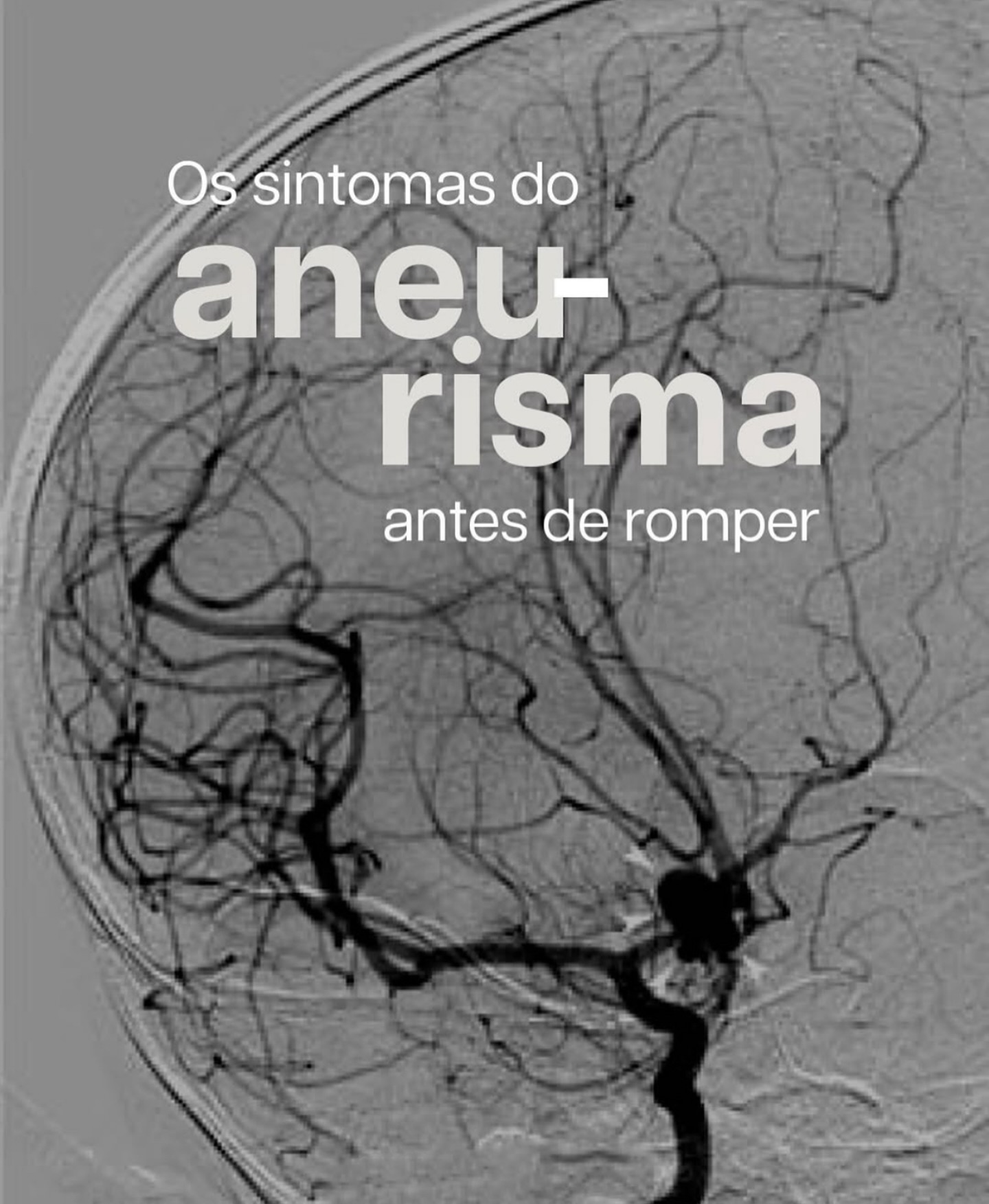 Dr. Paulo Xander Facebook ad: Você sabe identificar os sintomas de um aneurisma…