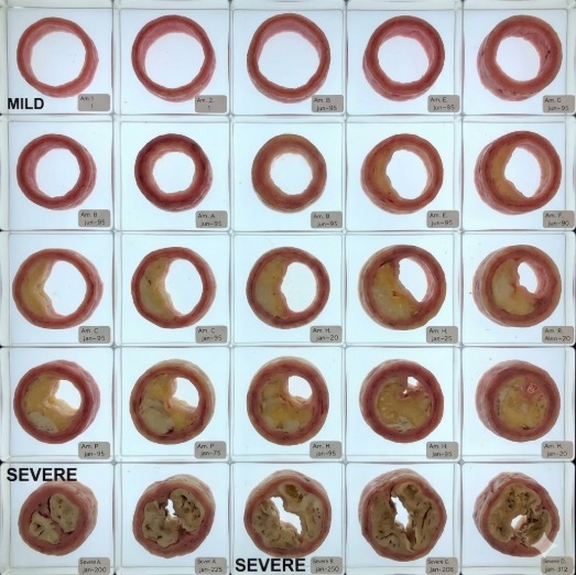 The Cholesterol Circle. Facebook ad