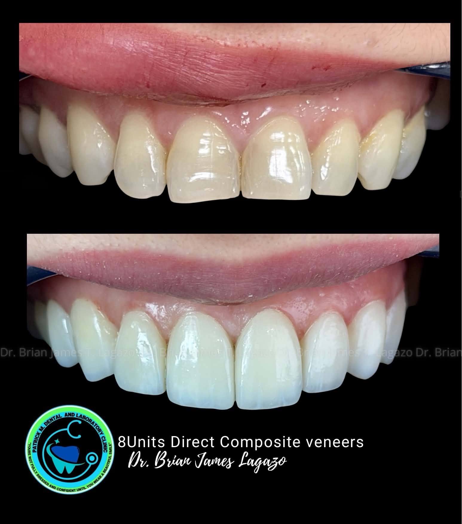 PMDCaL Lucena Facebook ad: Composite Veneers Upper