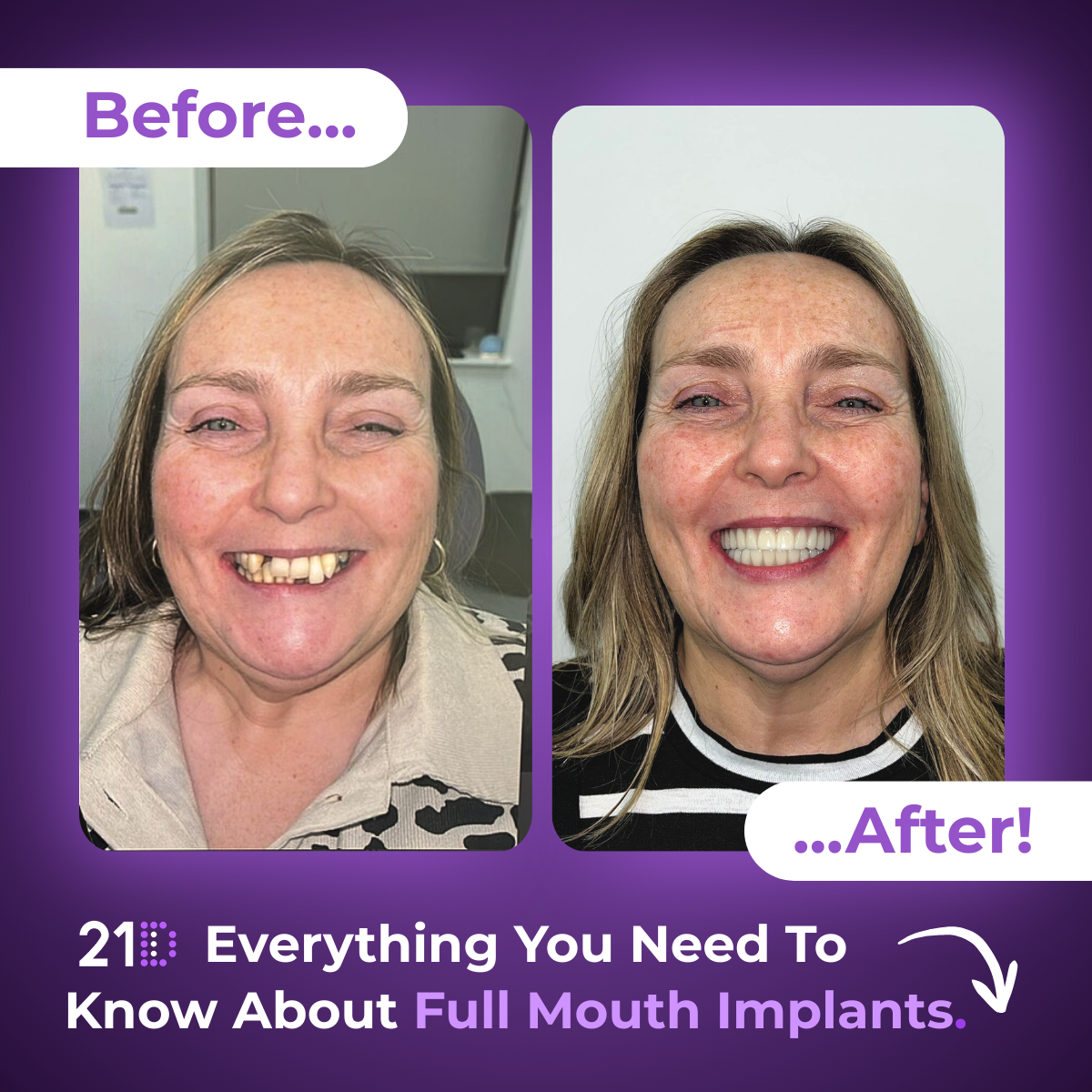21D: Exclusively Full Jaw Implant Solutions Facebook ad