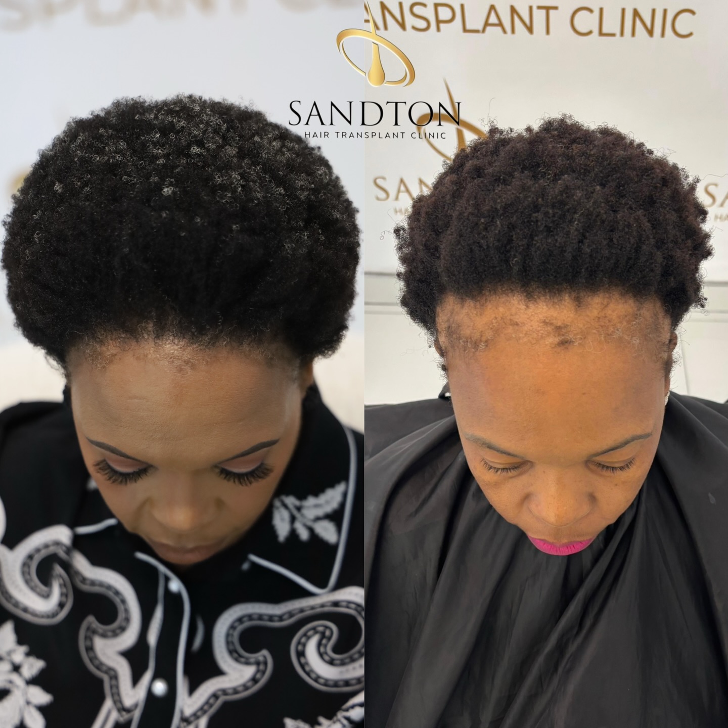 Sandton Hair Transplant Clinic Facebook ad