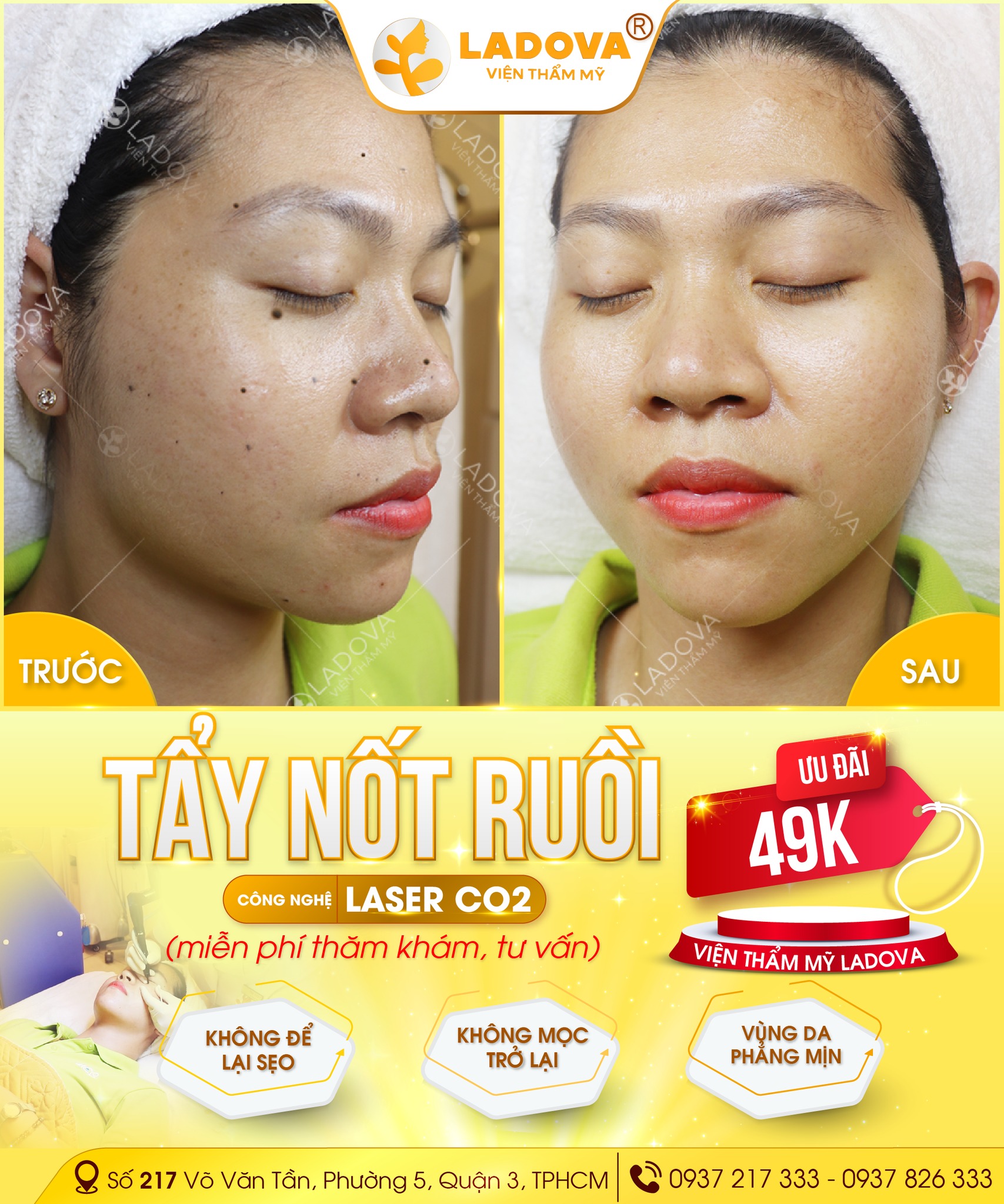 Tẩy Nốt Ruồi TPHCM Facebook ad