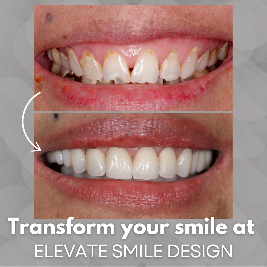 Elevate Smile Design Facebook ad: Transform your smile at Elevate Smile Design