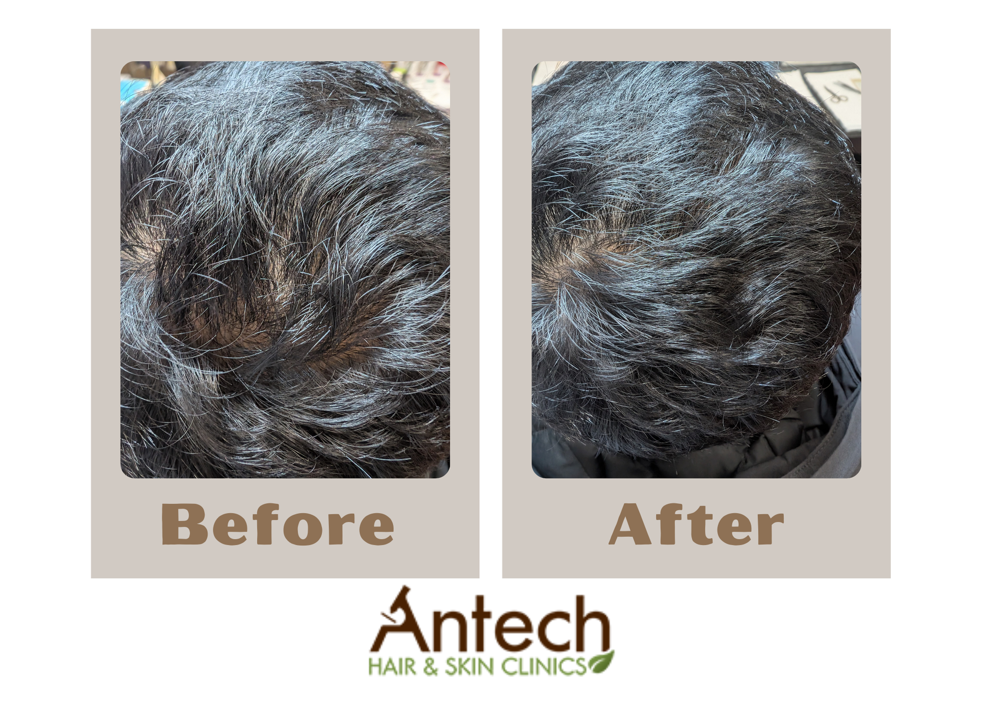 Antech Hair & Skin Clinic Facebook ad