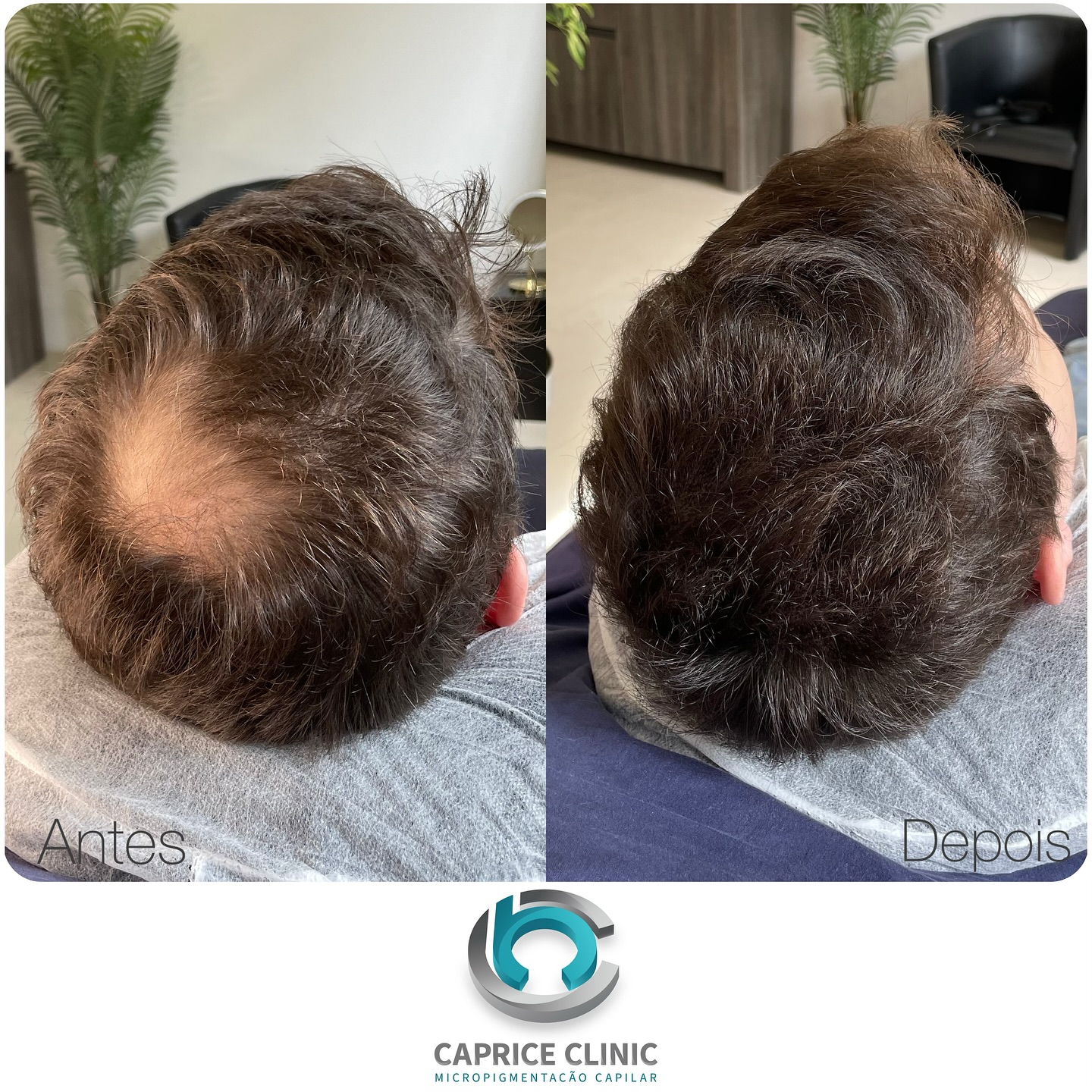 Caprice - Micropigmentação Capilar Facebook ad: Tratamento de densidade capilar com a