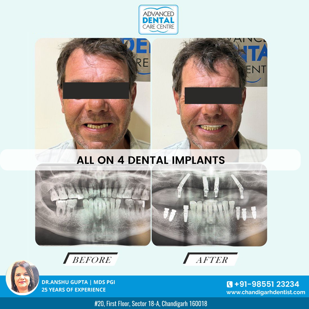 Advanced Dental Care Center Facebook ad from Dec 17, 2025