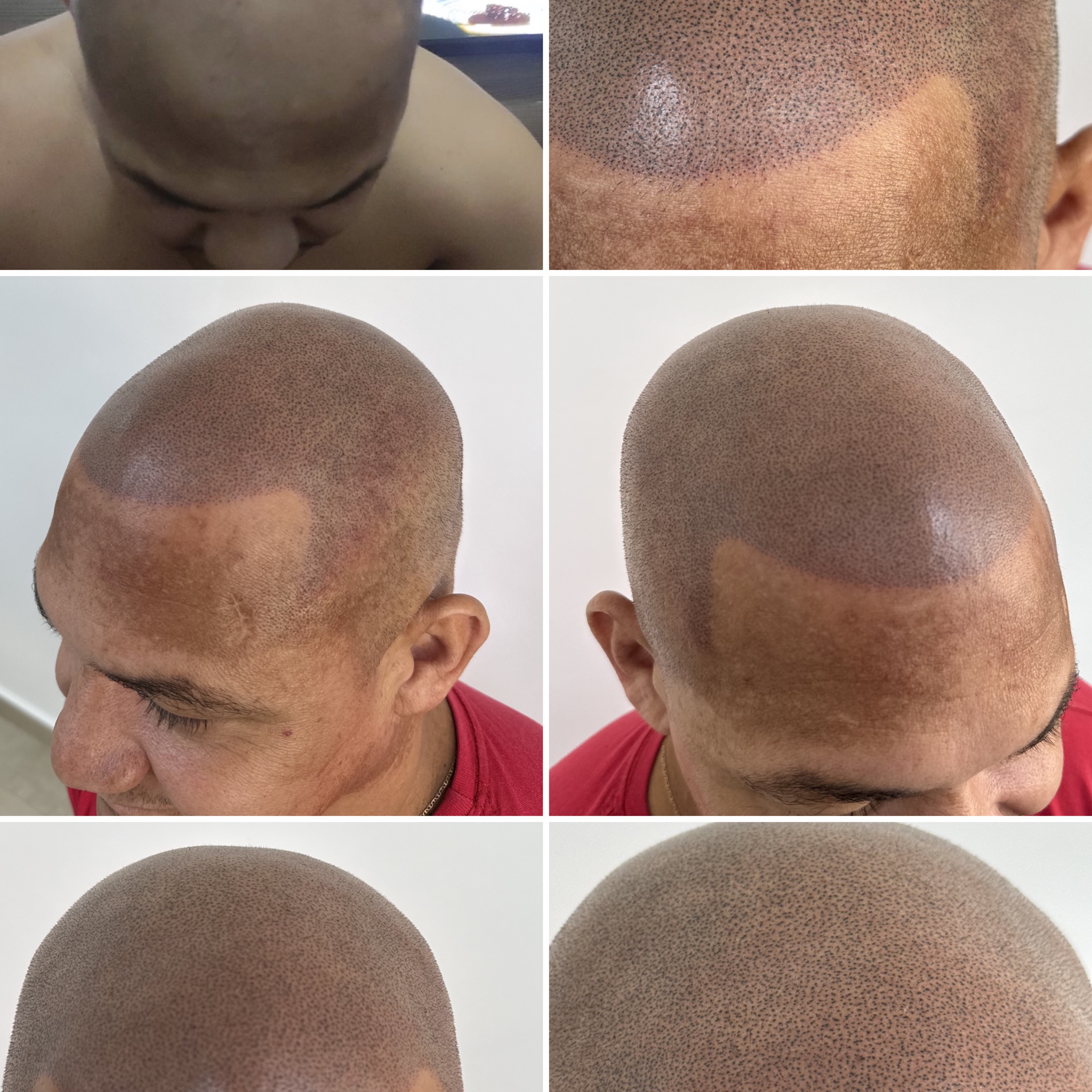 Ton Gois - Especialista em Micropigmentação Capilar Facebook ad
