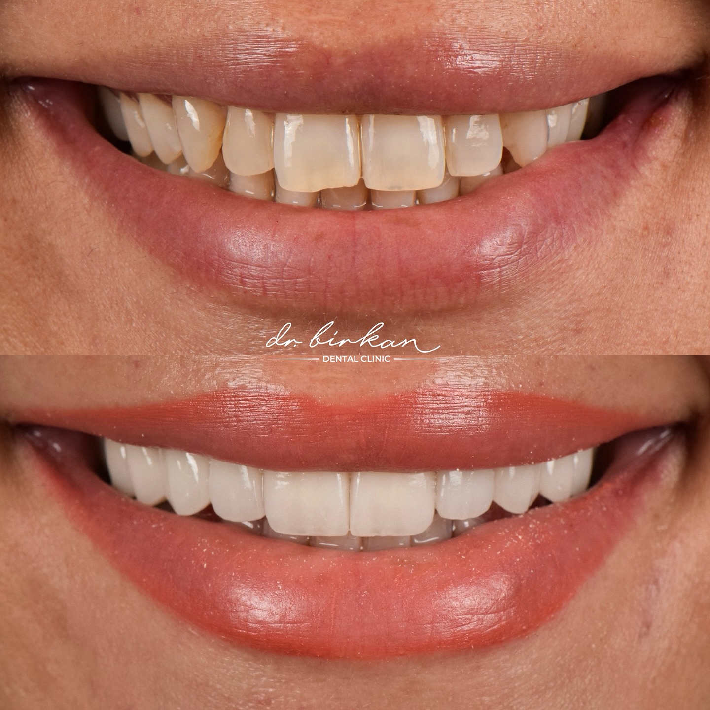 Dr. Birkan Duras Clinic Facebook ad: Transformation with Natural Veneers
