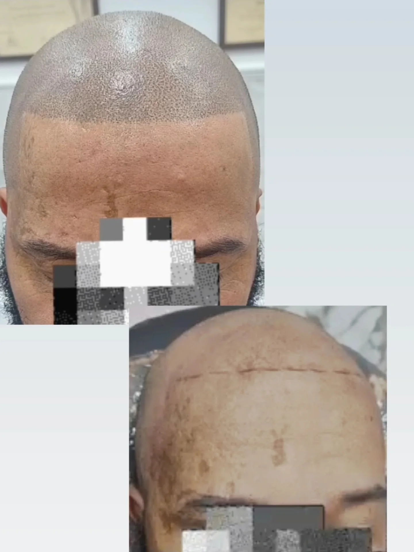 si_microcapilar Facebook ad: Será que a micropigmentação capilar é para mim?