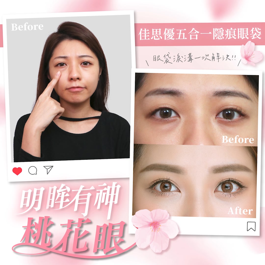 佳思優整形醫美診所| Just You Aesthetic Clinic Facebook ad: 30000 五合一眼袋手術 - 藝人指定