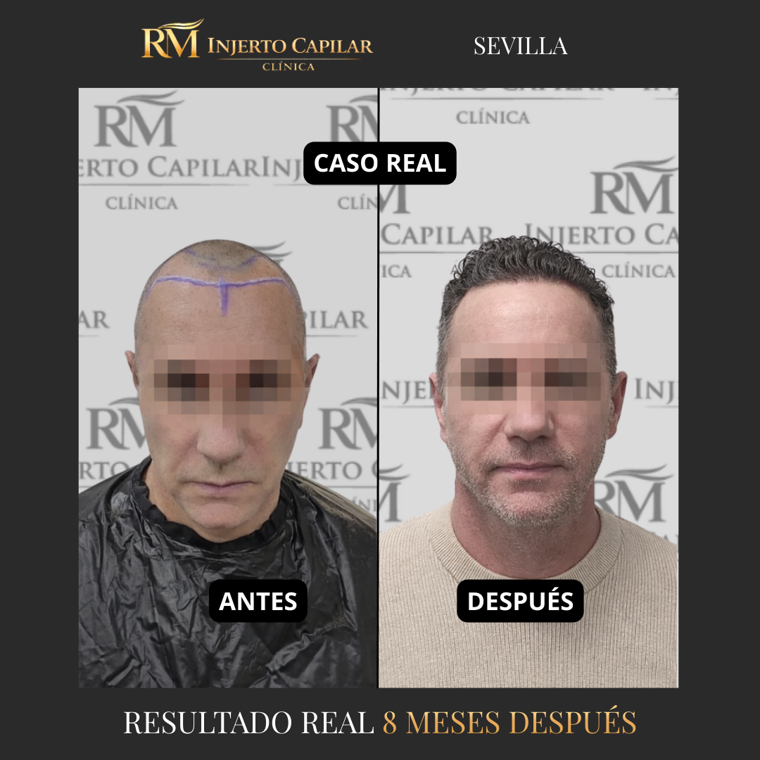 RM Injerto Capilar Facebook ad: Resultados reales de injerto capilar