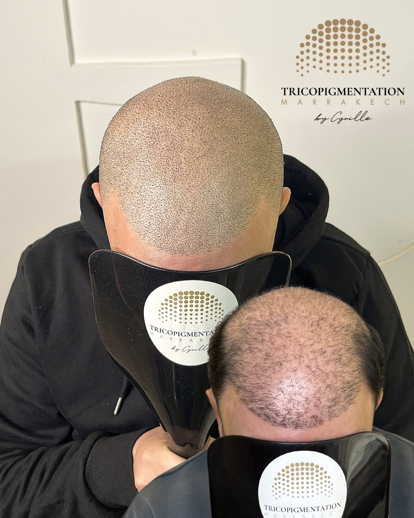 Tricopigmentation Marrakech. Facebook ad: Transition réussie pour Younes!