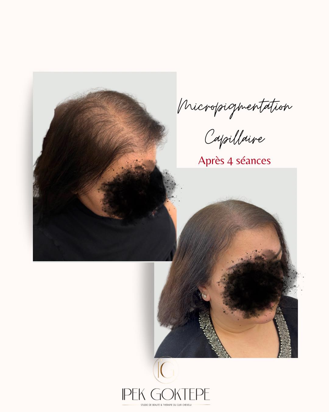 Ipek G. Dermographe Facebook ad: Un résultat bluffant après 4 séances de micropigmentation…