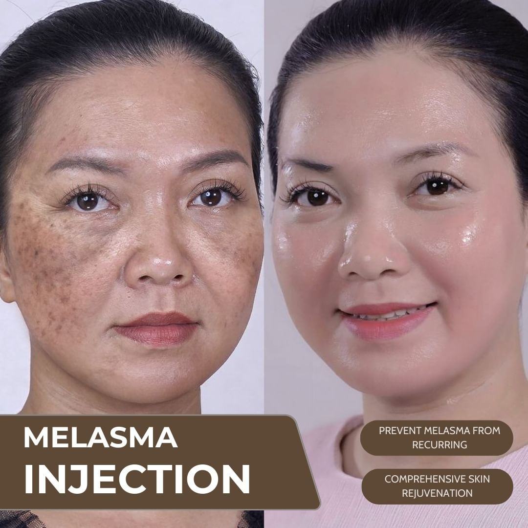 Jolie Beauty JohorBahru Facebook ad: LONG-TERM MELASMA - TREATMENT?
