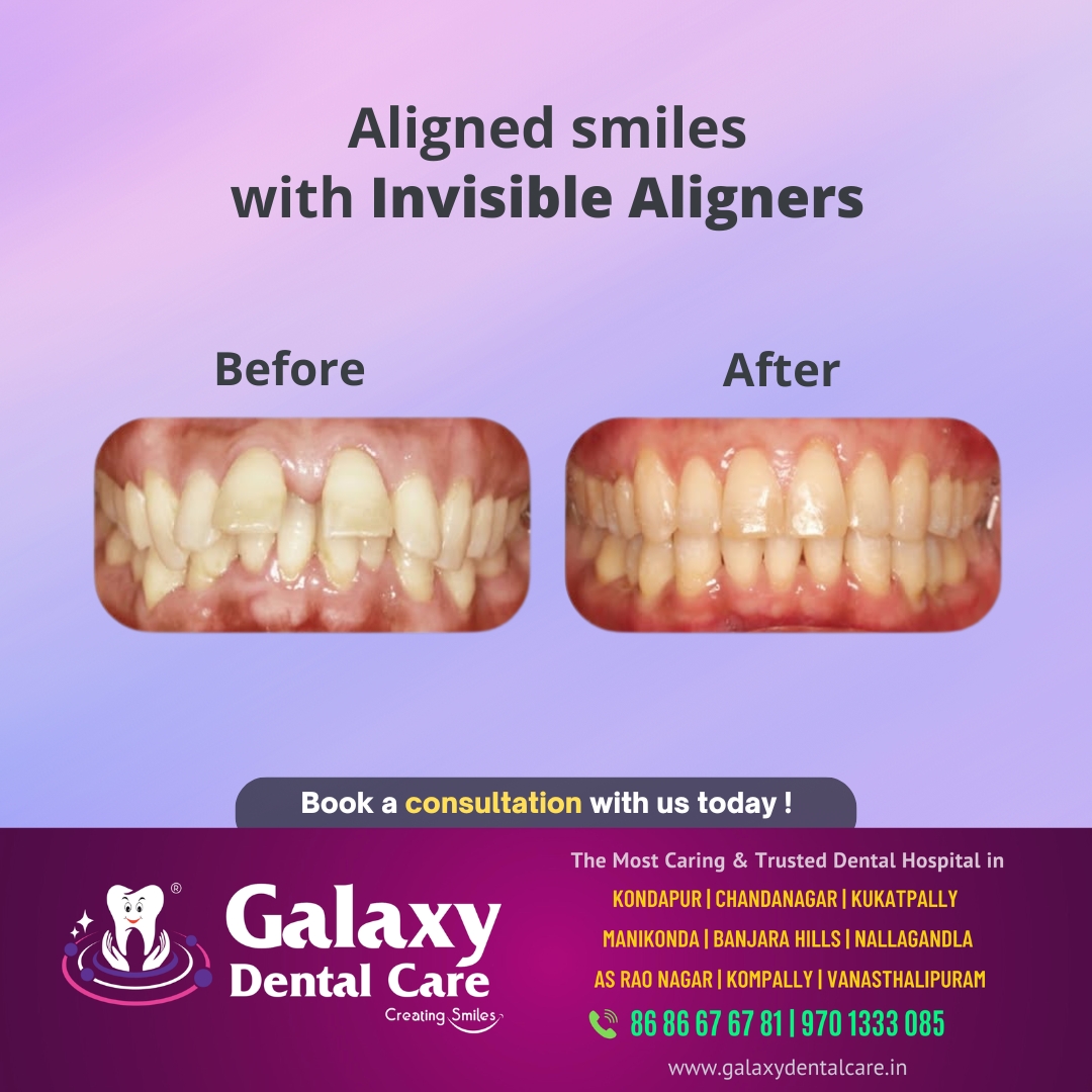 galaxy.dentalcare Facebook ad: Straighten your teeth with Invisible Aligners.