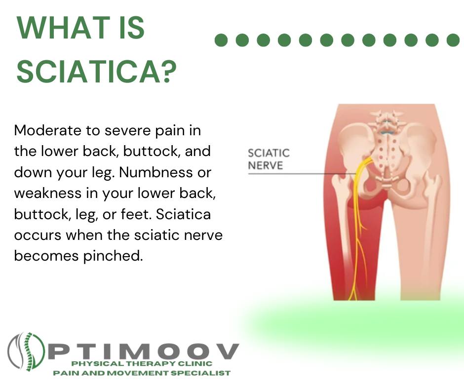 OptiMoov Physical Therapy Facebook ad: SCIATICA GONE