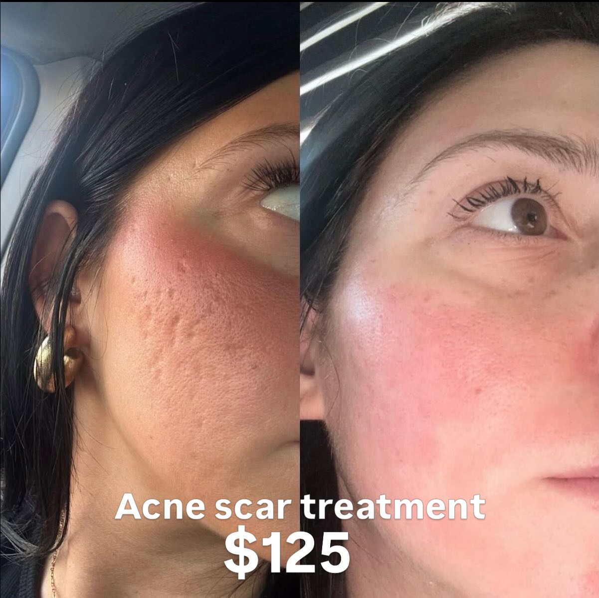 Spa Jolie Facebook ad: Our client loved her results after acne scar…