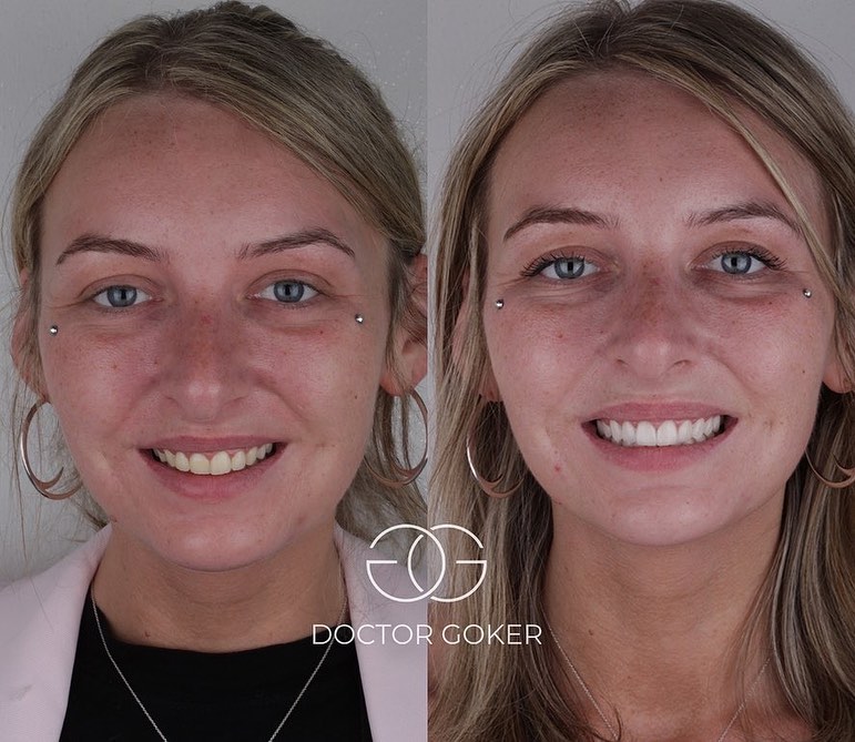 Gorkem Goker Facebook ad: 20 pieces of laminate veneers with gum correction