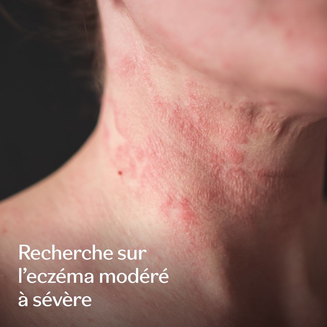 Eczema Research Study Facebook ad: Participez à un essai sur l’eczéma