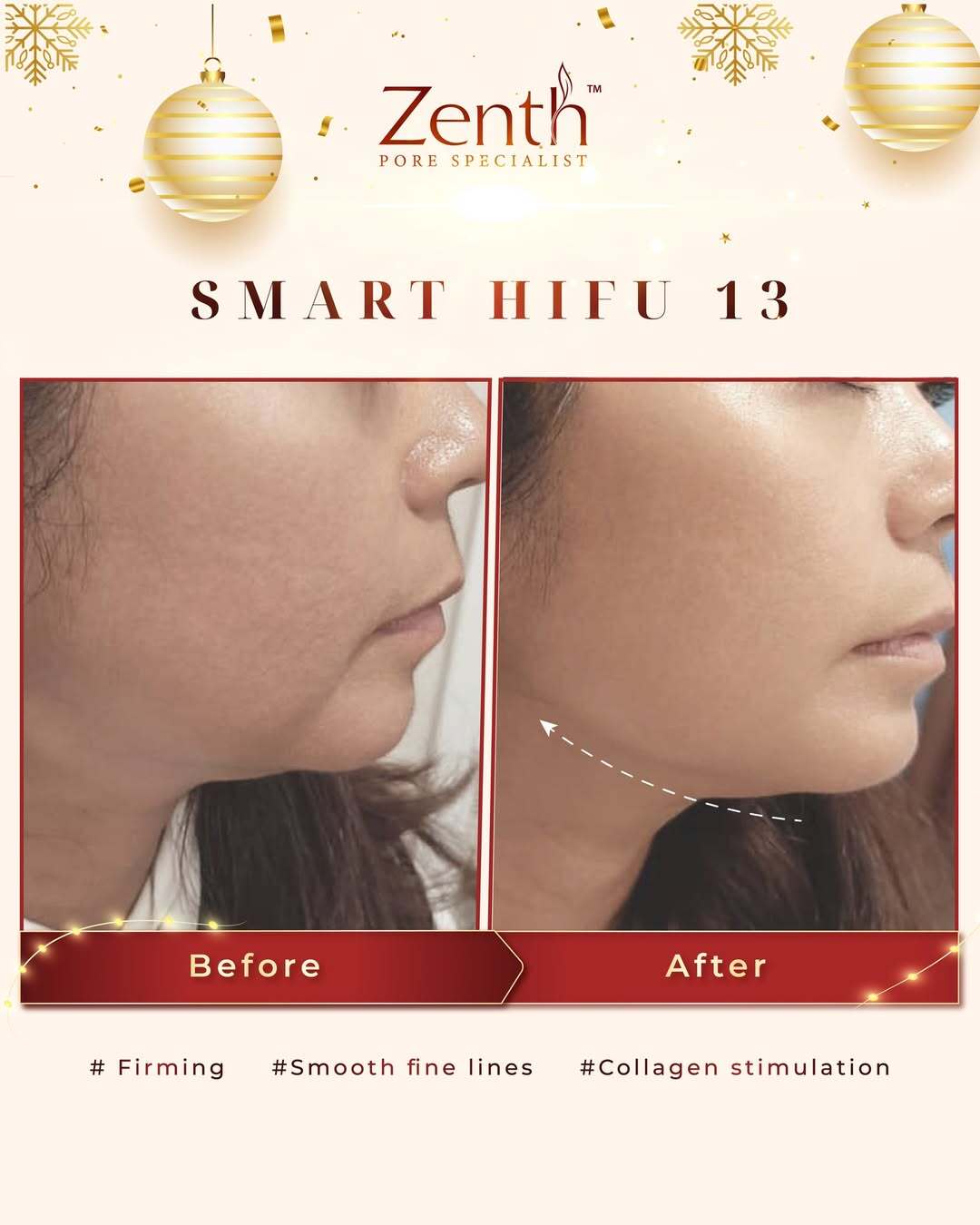Zenth Pore Specialist Facebook ad: No Pain No Downtime No Side Effects
