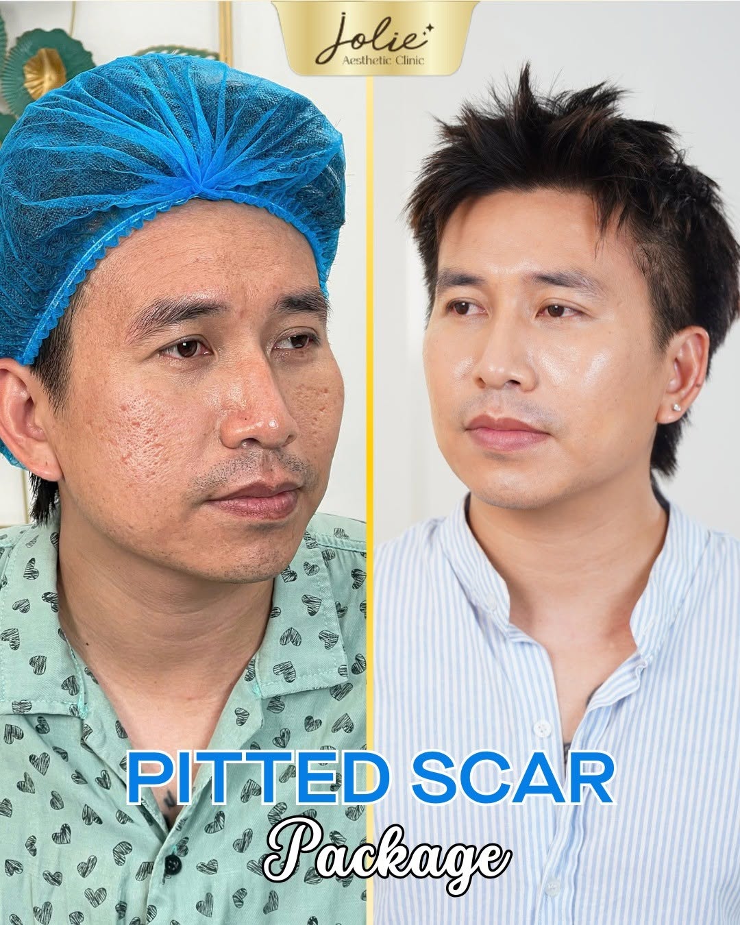 Jolie Ageless Beauty Johor Facebook ad: TREATS PITTED SCAR AT THE ROOT