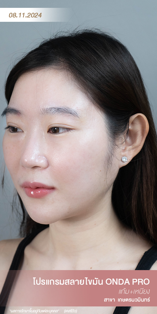 Jairuk Clinic -ใจรักษ์คลินิก Facebook ad: เคสคุณกิ๊ม Program ONDA PRO แก้ม + เหนียง